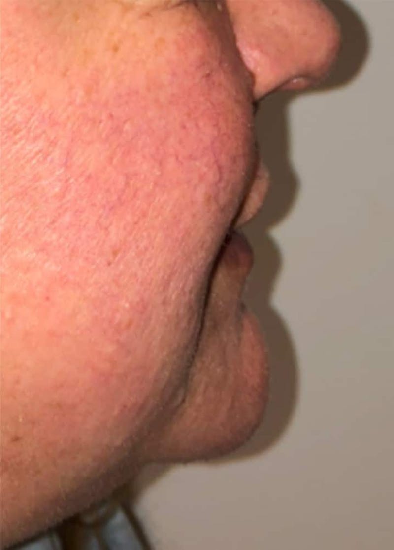 Surgical Lip Lift Before & After Gallery - Patient 591407 - Image 7