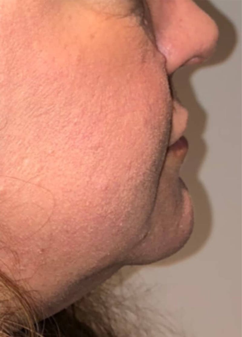 Surgical Lip Lift Before & After Gallery - Patient 591407 - Image 8