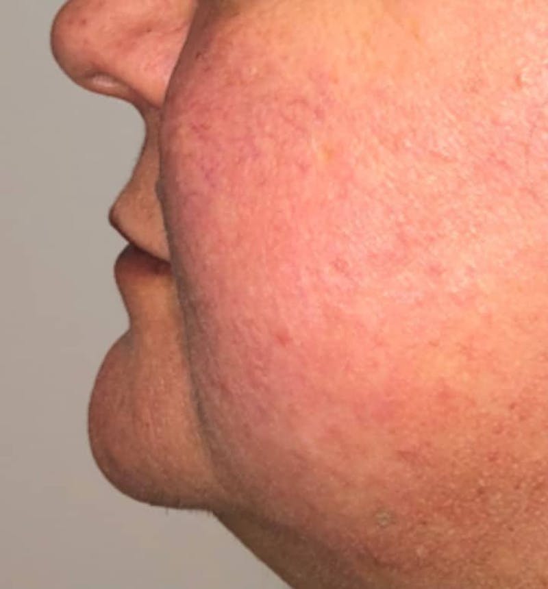 Surgical Lip Lift Before & After Gallery - Patient 591407 - Image 9