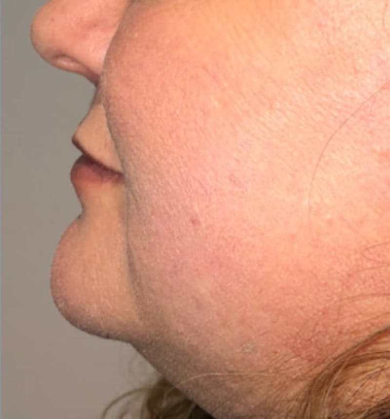 Surgical Lip Lift Before & After Gallery - Patient 591407 - Image 10