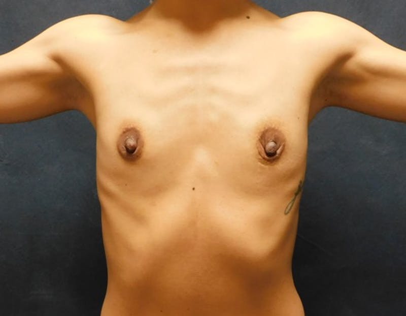 Breast Augmentation Before & After Gallery - Patient 700608 - Image 3