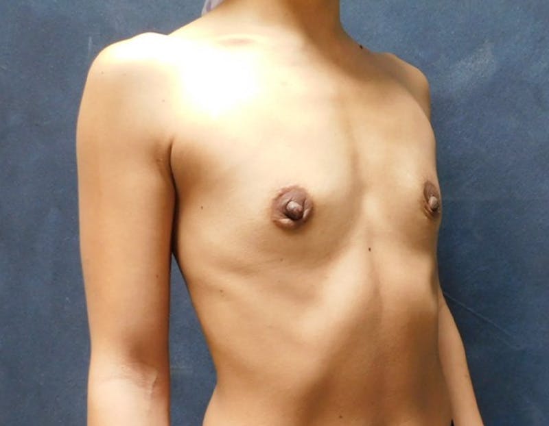 Breast Augmentation Before & After Gallery - Patient 700608 - Image 5
