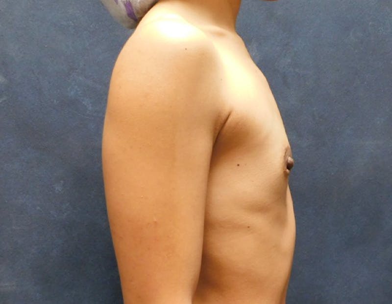 Breast Augmentation Before & After Gallery - Patient 700608 - Image 7