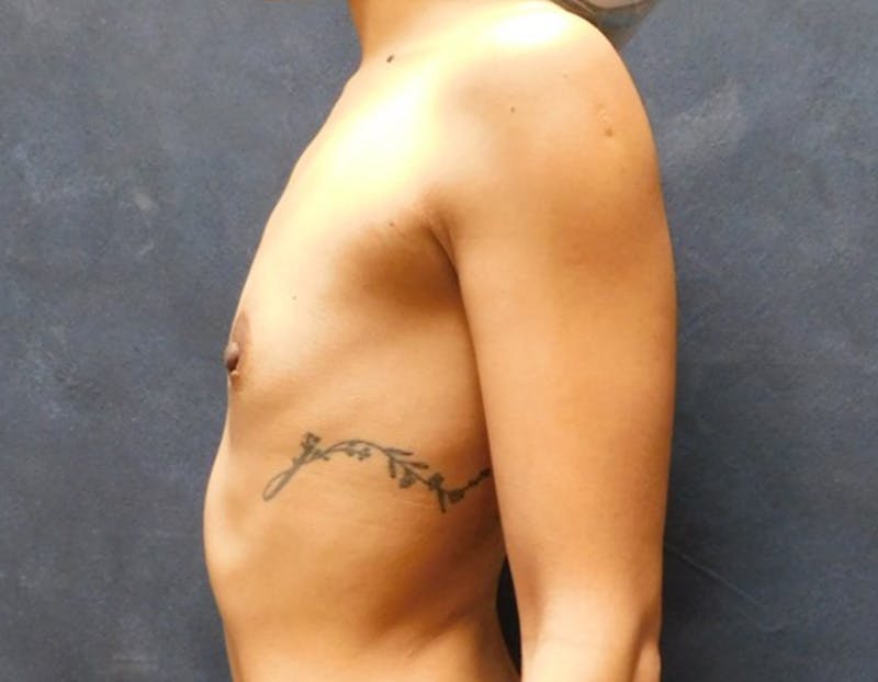 Breast Augmentation Before & After Gallery - Patient 700608 - Image 9