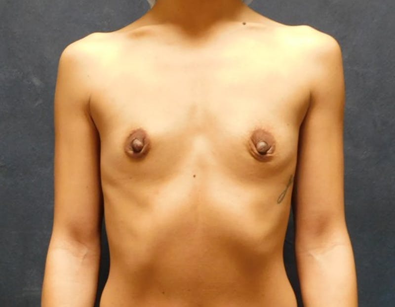 Breast Augmentation Before & After Gallery - Patient 700608 - Image 1