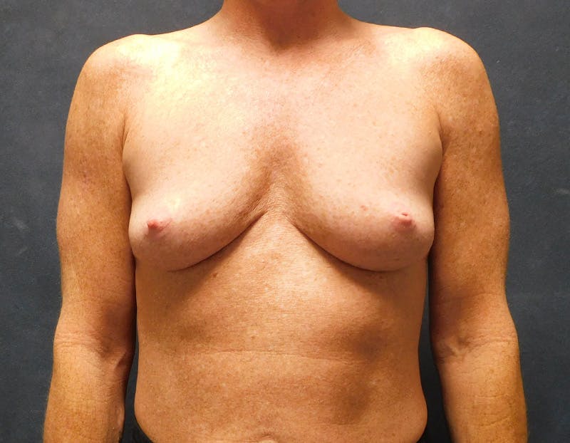 Breast Augmentation Before & After Gallery - Patient 109012 - Image 1