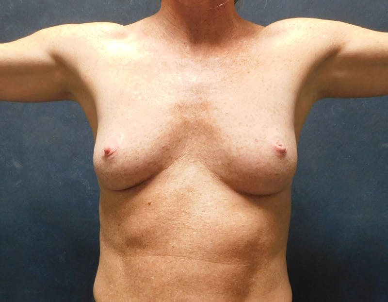 Breast Augmentation Before & After Gallery - Patient 109012 - Image 3