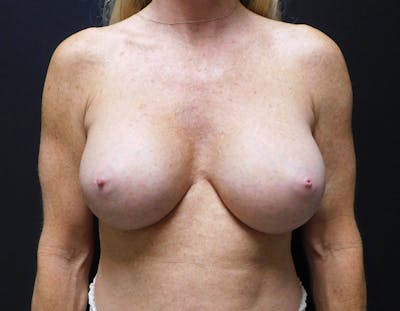 Breast Augmentation Before & After Gallery - Patient 109012 - Image 2