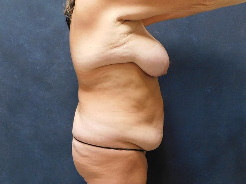 Tummy Tuck Before & After Gallery - Patient 387089 - Image 11