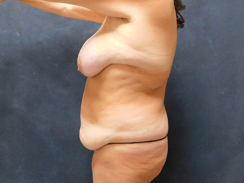 Tummy Tuck Before & After Gallery - Patient 387089 - Image 19