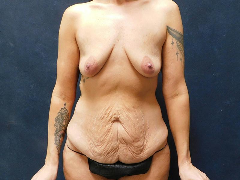 Tummy Tuck Before & After Gallery - Patient 334068 - Image 1