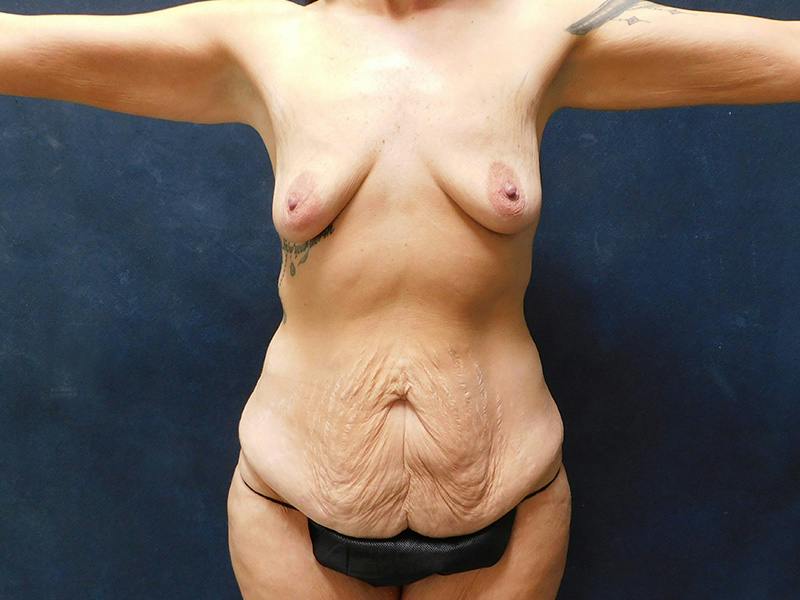 Tummy Tuck Before & After Gallery - Patient 334068 - Image 3