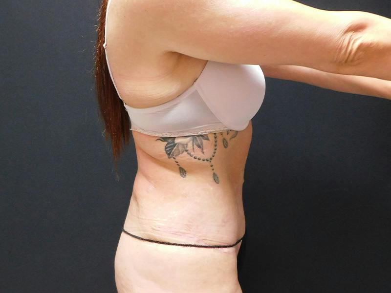 Tummy Tuck Before & After Gallery - Patient 334068 - Image 10