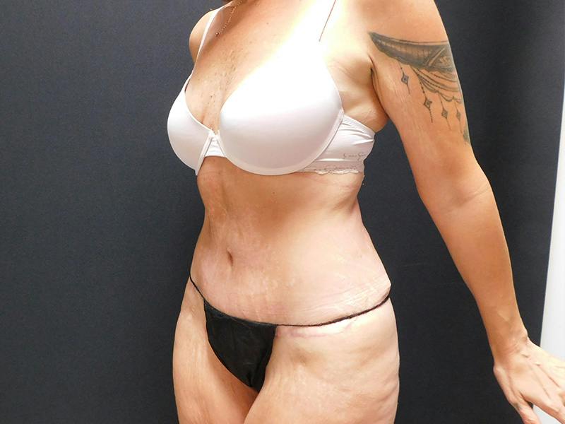 Tummy Tuck Before & After Gallery - Patient 334068 - Image 12