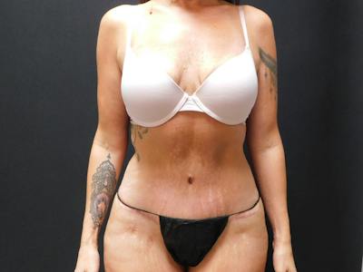 Tummy Tuck Before & After Gallery - Patient 334068 - Image 2