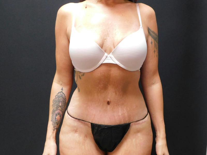 Tummy Tuck Before & After Gallery - Patient 334068 - Image 2