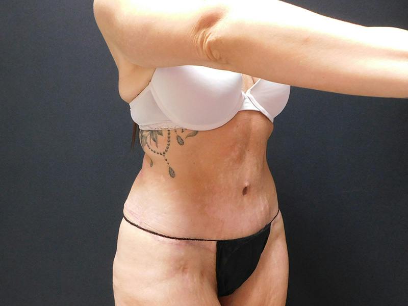 Tummy Tuck Before & After Gallery - Patient 334068 - Image 8