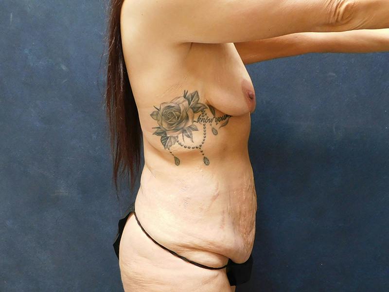 Tummy Tuck Before & After Gallery - Patient 334068 - Image 9
