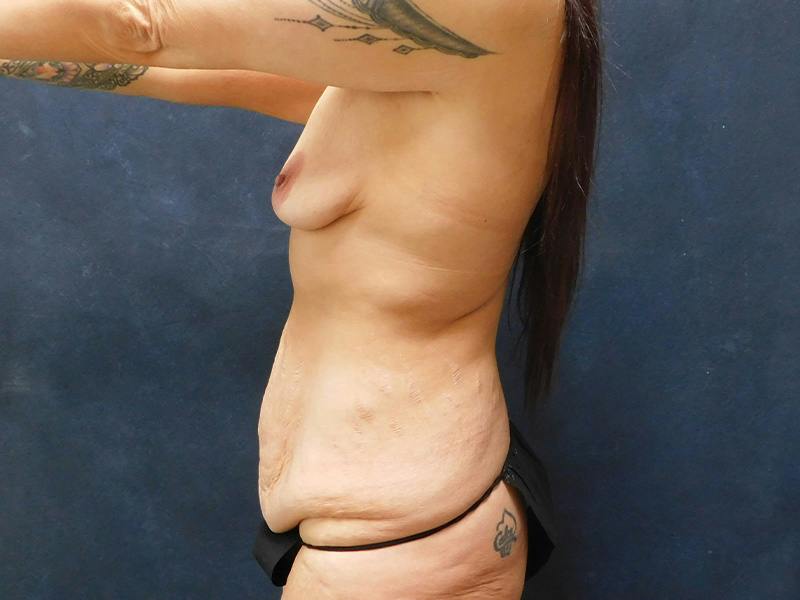 Tummy Tuck Before & After Gallery - Patient 334068 - Image 13