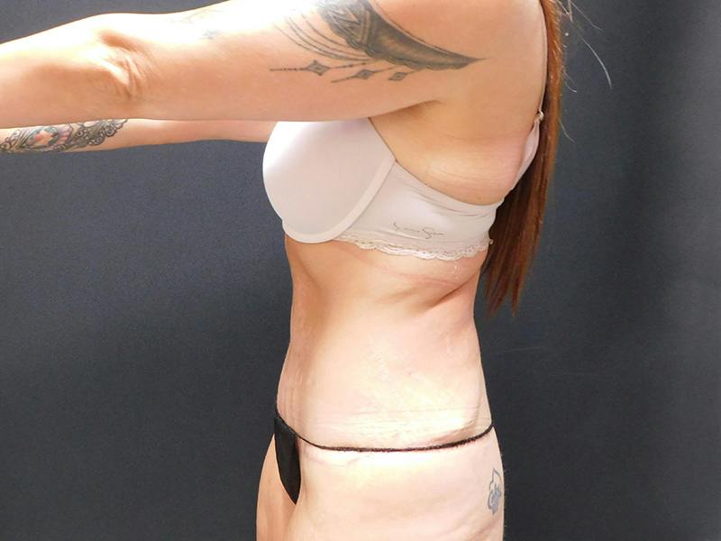 Tummy Tuck Before & After Gallery - Patient 334068 - Image 14