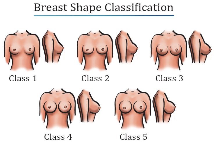 Breast Shape Classification Diagram