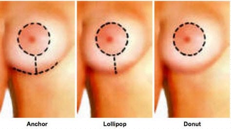 Should I Get a Breast Lift or a Breast Reduction?