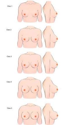 breast-shape-classification