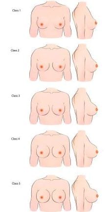 Breast Shape Classification  Classification for Breast Shape