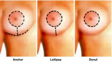 Breast lift incision diagram
