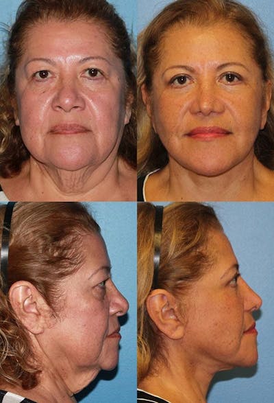 Face Lift Before & After Gallery - Patient 2158291 - Image 1