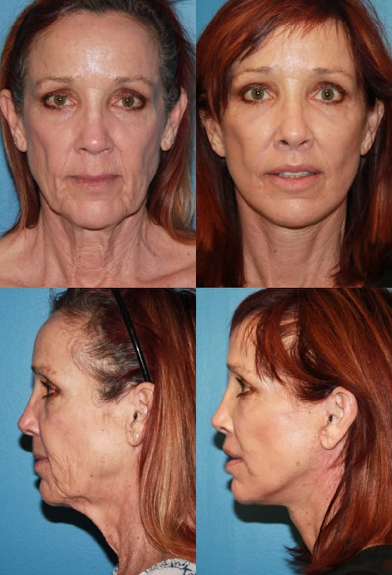 Face Lift Gallery - Patient 2158292 - Image 1