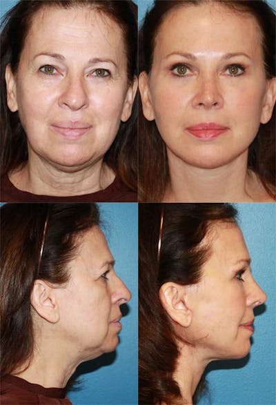 Facelift Before and After  Ranch & Coast Plastic Surgery