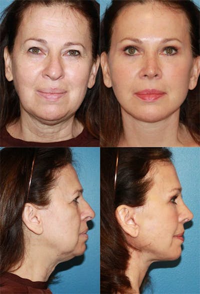 Mini Facelift / Petit Lift Before & After Gallery - Patient 143567098 - Image 1