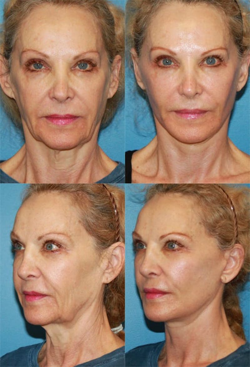 Face Lift Before & After Gallery - Patient 2158297 - Image 1