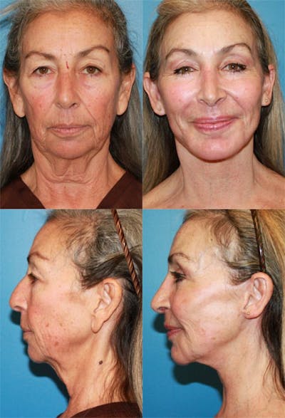 Face Lift Before & After Gallery - Patient 2158298 - Image 1