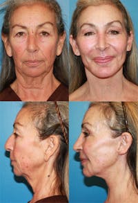 Face Lift Before & After Gallery - Patient 2158298 - Image 1