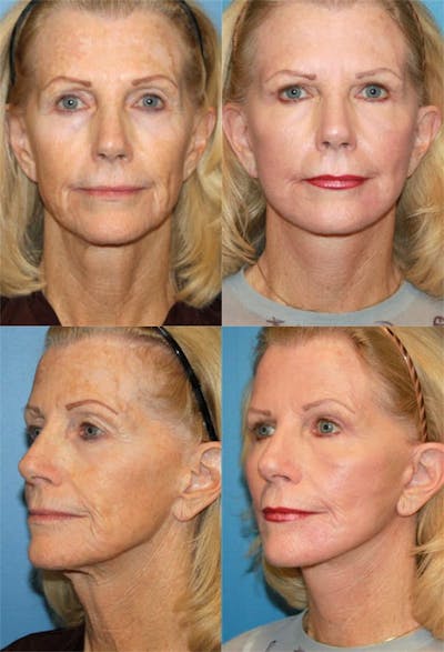 Mini Facelift / Petit Lift Before & After Gallery - Patient 143567103 - Image 1