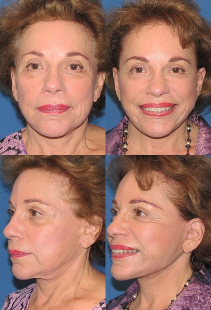 Mini Facelift / Petit Lift Before & After Gallery - Patient 143567104 - Image 1