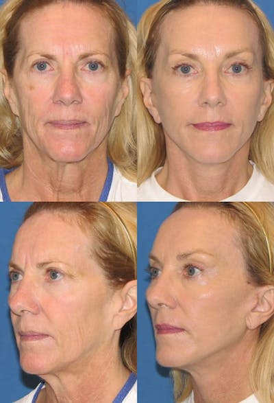 Mini Facelift / Petit Lift Before & After Gallery - Patient 143567105 - Image 1