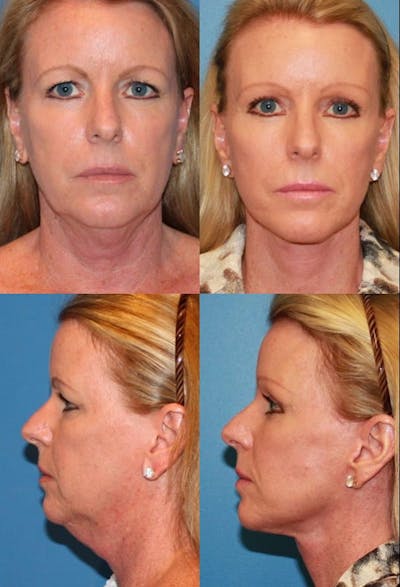 Facelift Before and After  Ranch & Coast Plastic Surgery