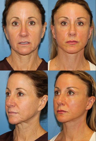 Mini Facelift / Petit Lift Before & After Gallery - Patient 143567109 - Image 1