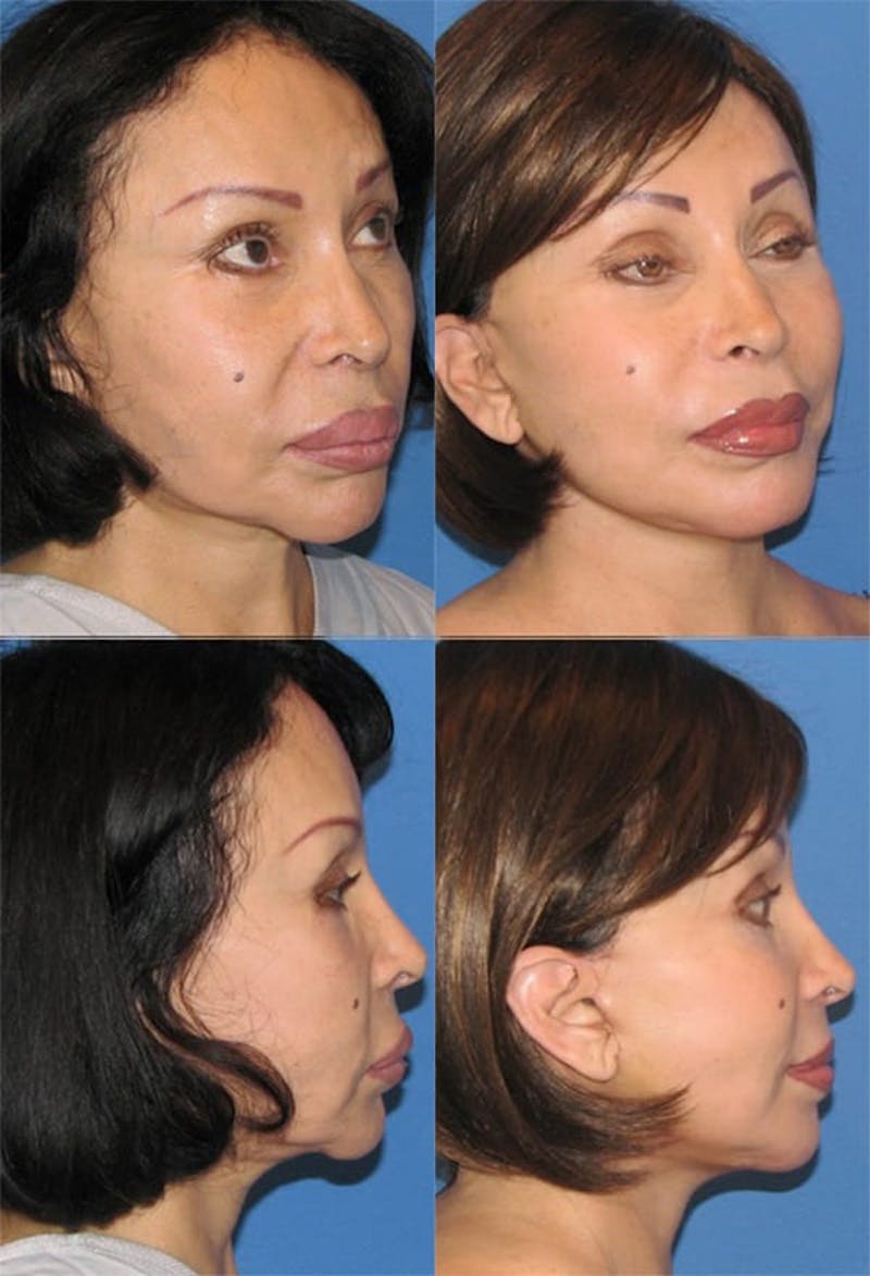 Mini Facelift / Petit Lift Before & After Gallery - Patient 143567110 - Image 1