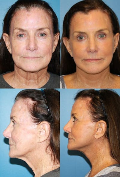 Face Lift Before & After Gallery - Patient 2158308 - Image 1