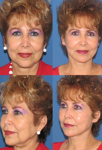 Mini Facelift / Petit Lift Before & After Gallery - Patient 143567112 - Image 1