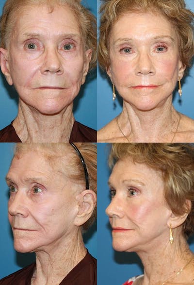 Face Lift Before & After Gallery - Patient 2158316 - Image 1