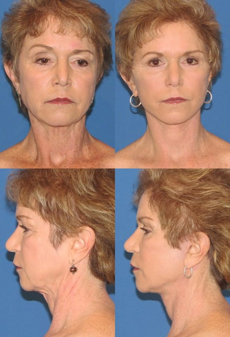 Mini Facelift / Petit Lift Before & After Gallery - Patient 143567115 - Image 1