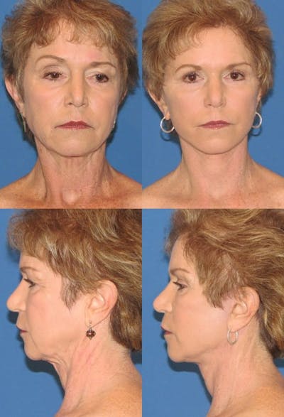 Mini Facelift / Petit Lift Before & After Gallery - Patient 143567115 - Image 1