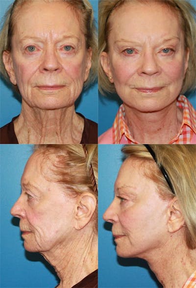 Face Lift Before & After Gallery - Patient 2158320 - Image 1