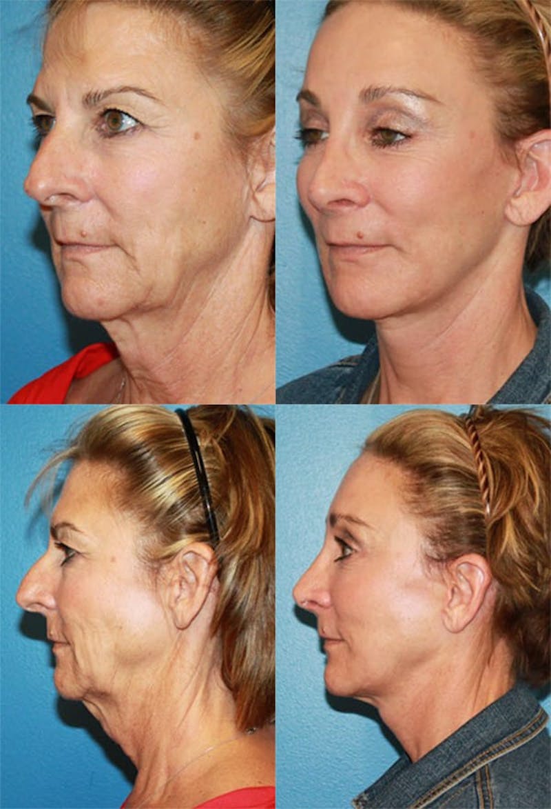 Face Lift Before & After Gallery - Patient 2158324 - Image 1