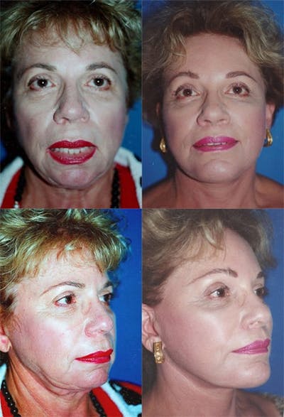 Face Lift Gallery - Patient 2158327 - Image 1